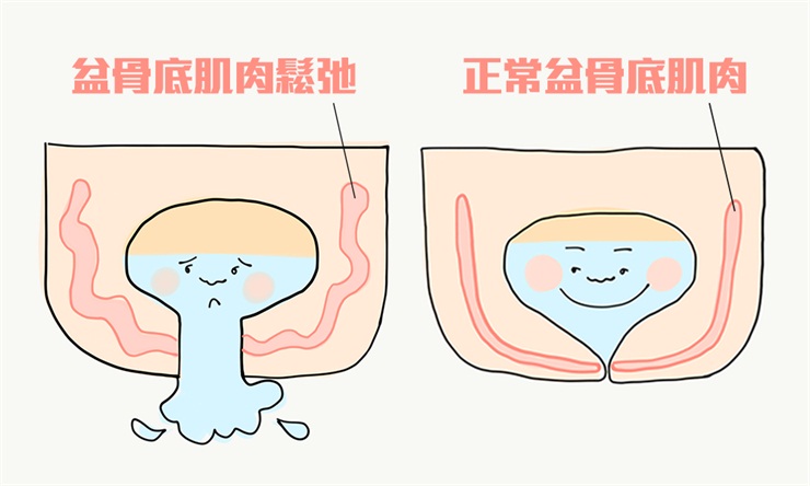 盆底肌康复治疗