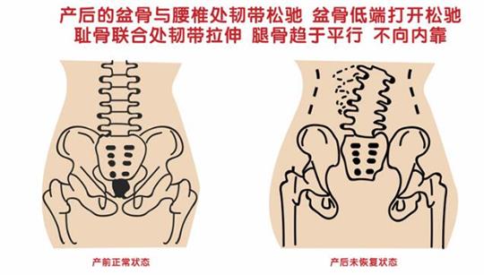 盆底肌修复