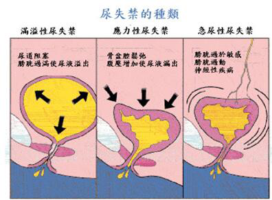 产后盆底肌修复