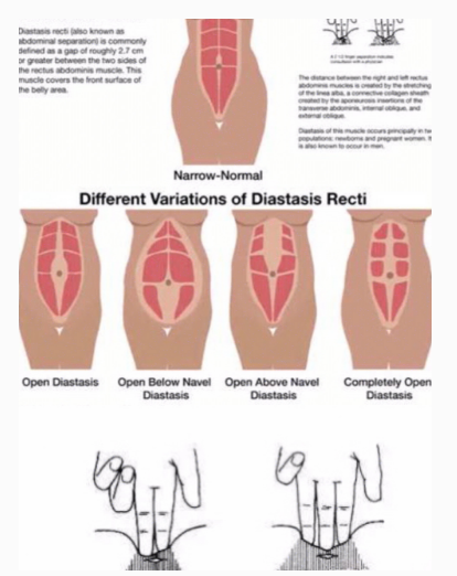 产后腹直肌分离