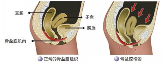 盆底肌修复