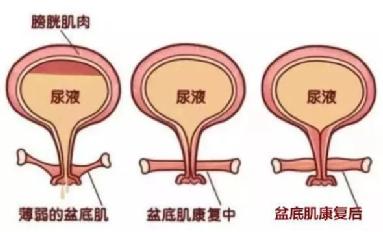 盆底肌修复仪器.jpg